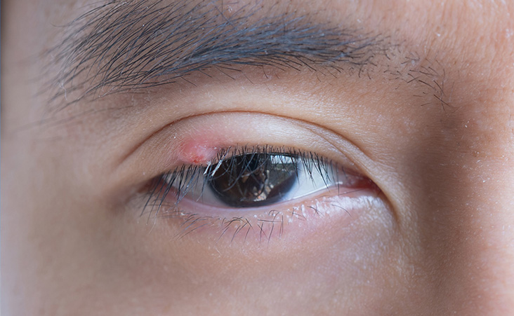 Orgelet et chalazion